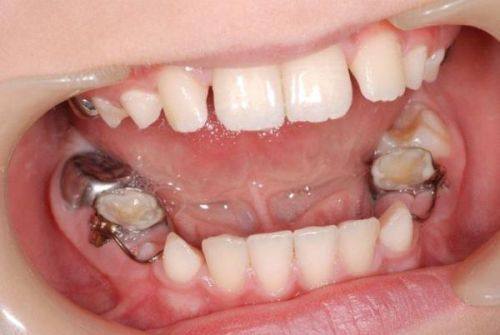 三、瑞典诺贝尔种植牙怎么选？实用攻略帮你决策