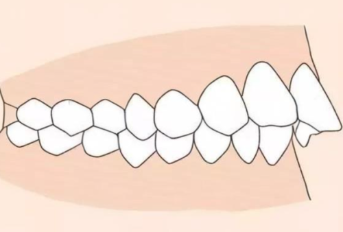 二、37岁地包天矫正，方案需根据地包天类型定制