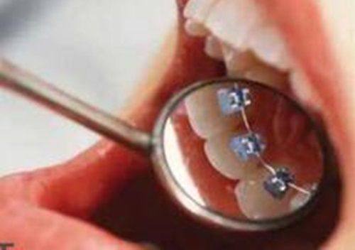 五、洗牙后发现牙损伤？可能是自身问题被误判