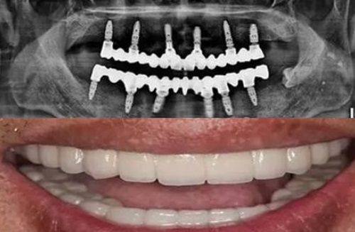 二、30岁正畸的可行性:技术成熟,无年龄门槛