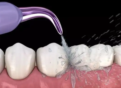 五、如何预估自己的洗牙时长