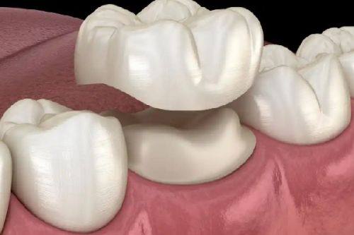 三、小苏打洗牙的正确用法,你用对了吗?