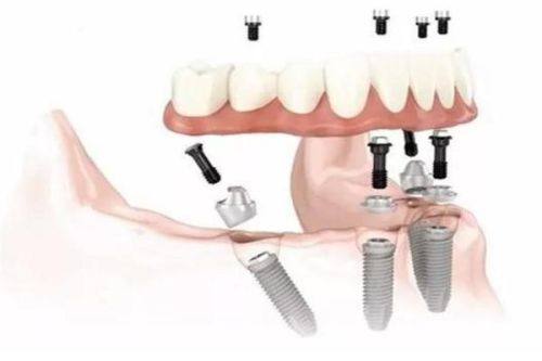 二、牙齿抛光:决定洗牙成效“保质期”的关键一步