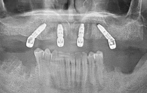 三、日常口腔护理习惯:拉长洗牙成效时长的核心