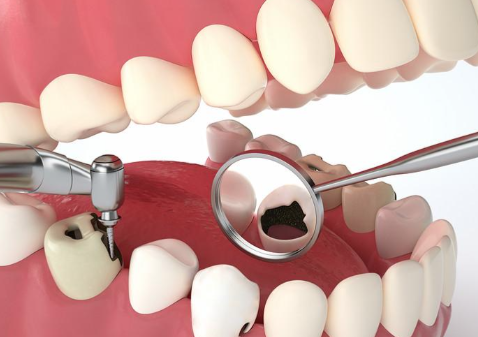 四、饮食生活习惯:悄悄缩短洗牙成效的“隐形杀手”