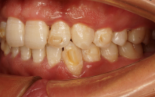 三、哪些情况洗牙会真正损伤牙齿？