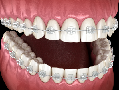 三、18岁之前拔牙会有事吗