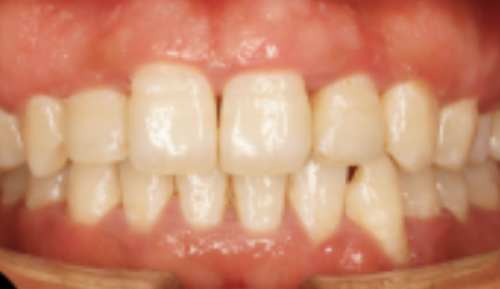 三、小孩换牙晚上能拔牙吗?需先明确就诊指征