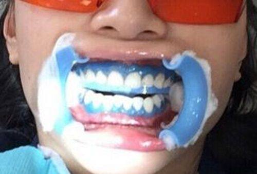 四、全瓷牙可以吃炒的花生吗