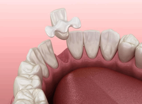 五、全瓷牙日常饮食的其他注意事项