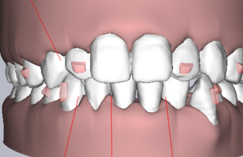 二、矫正拔牙后多久可以正常喝水
