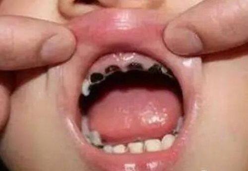 三、牙根没坏为什么会牙疼？