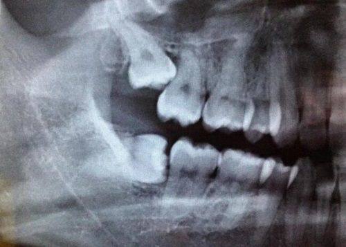 三、标准根管治疗流程是怎样的？