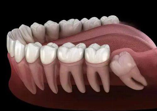 三、补牙后持续疼痛的应急缓解方式