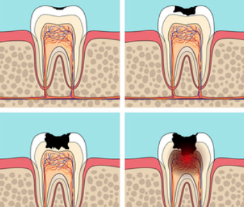 四、牙根没坏可以直接补牙吗？
