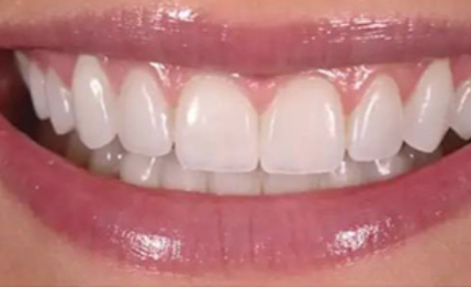 二、哪些情况需要做根管治疗？