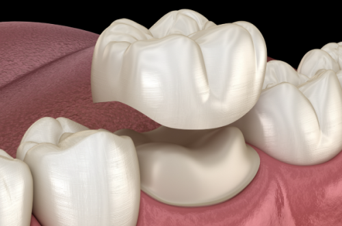 即刻种植的适应症与专属优势