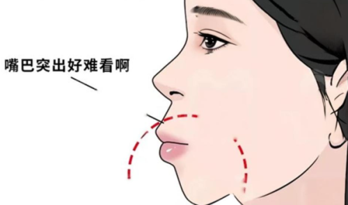 四、专精矫正器选择:需在医生评估后使用