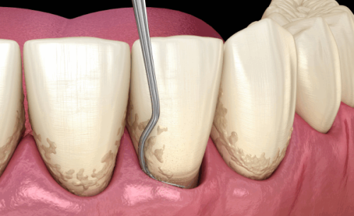 三、青少年做根管治疗多少钱