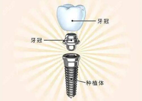 四、青少年根管治疗后至佳方案是什么