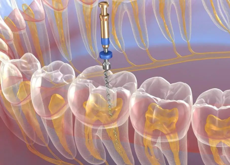三、根管治疗后牙齿反复发炎的常见诱因