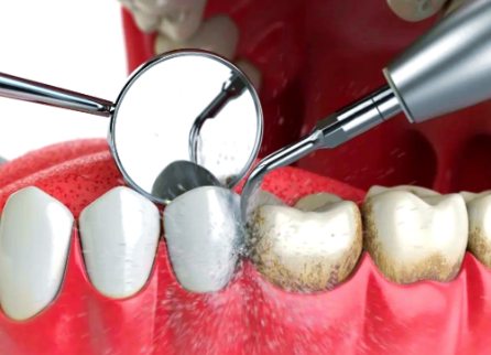 二、欧美高端植体：高端需求的放心选择