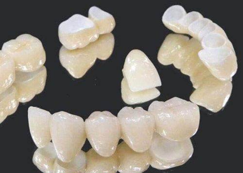 四、全瓷牙能管多久多少年？核心影响因素拆解