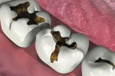 四、即刻种植的优势与弊端